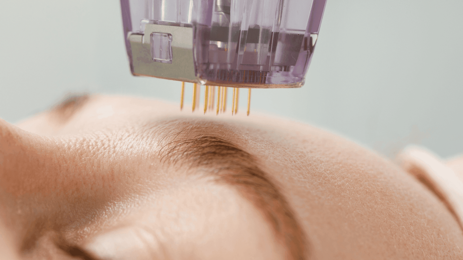 RF Microneedling