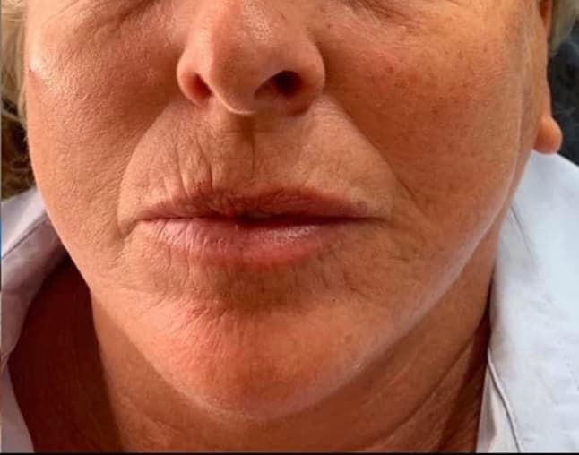 Skin Boosters & Dermal Fillers after
