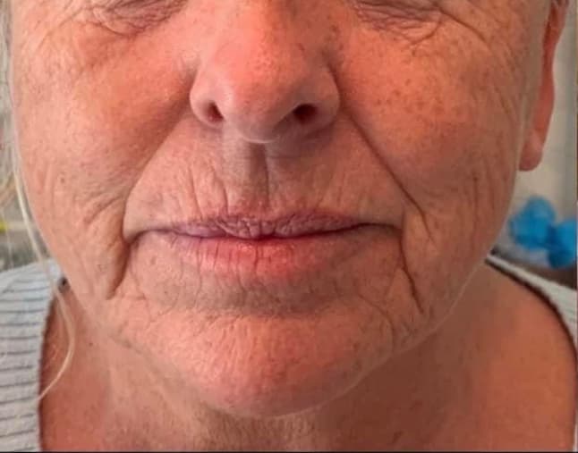 Skin Boosters & Dermal Fillers before