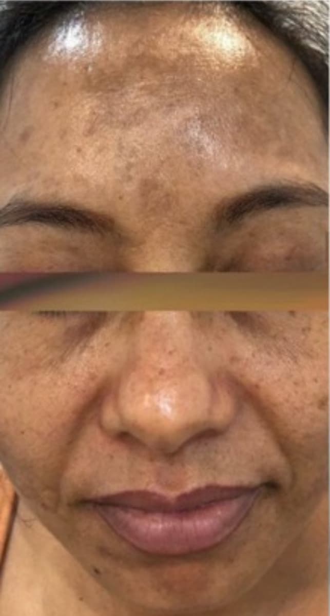 Chemical Peel Series before