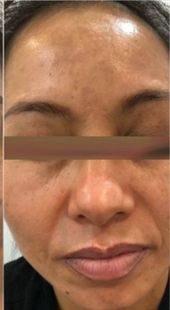 Chemical Peel Series after