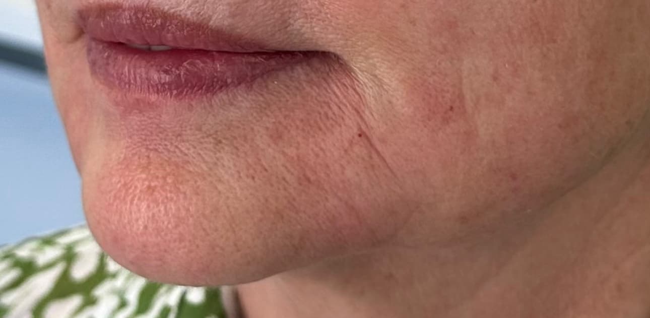 Lip Enhancement after