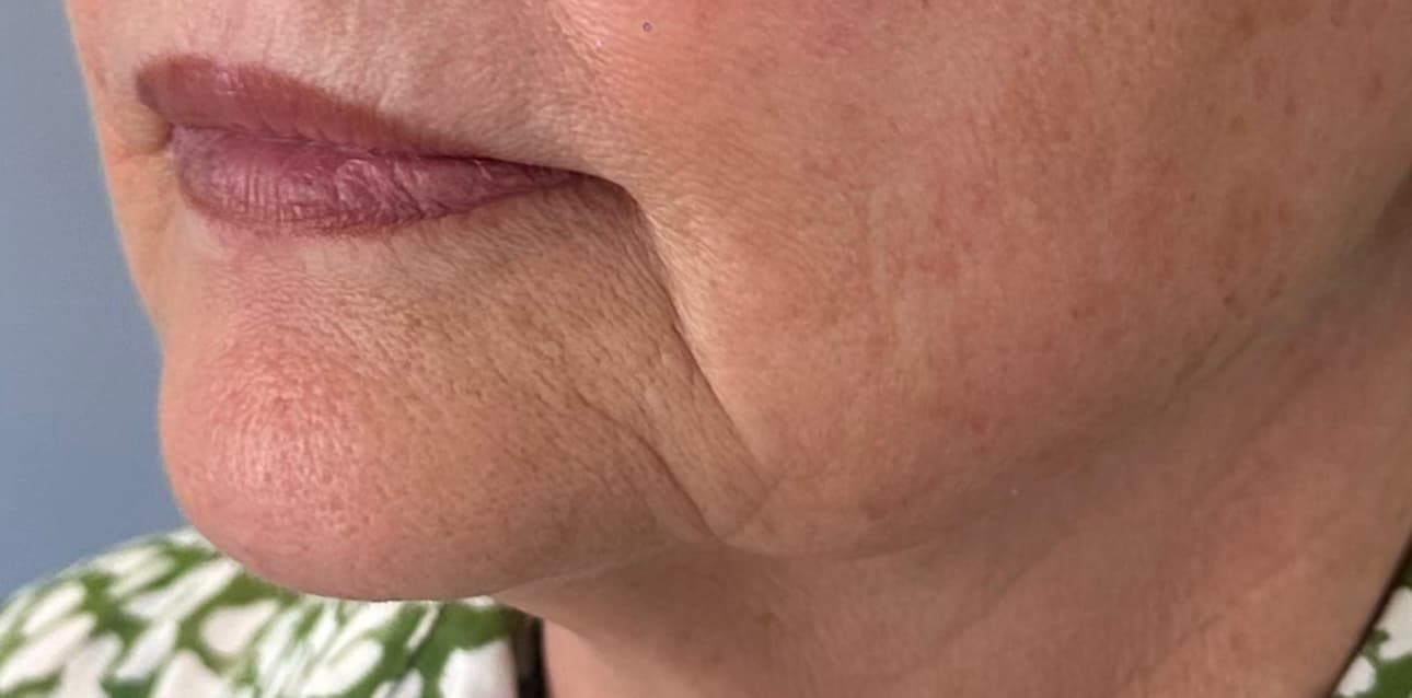 Lip Enhancement before