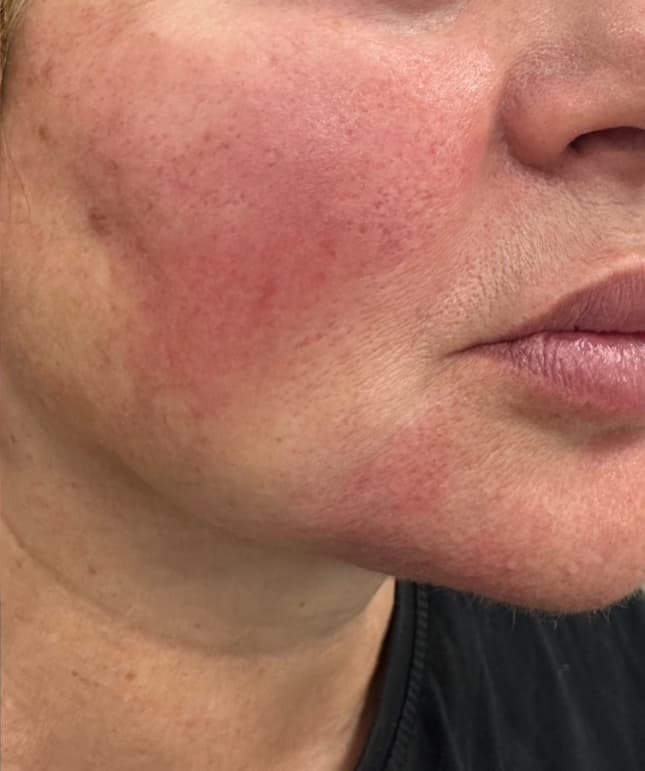 Cheek Augmentation after