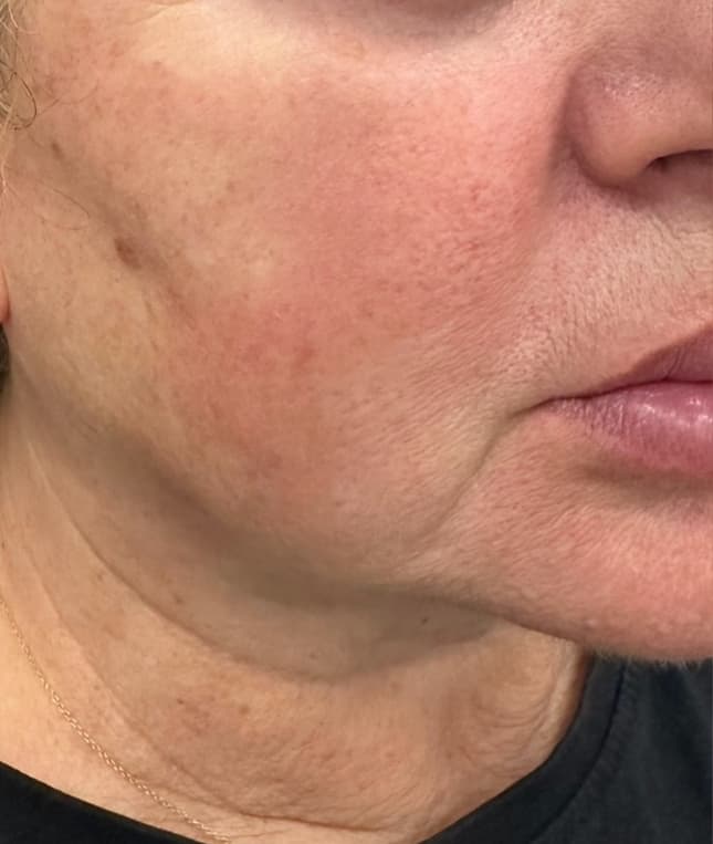 Cheek Augmentation before