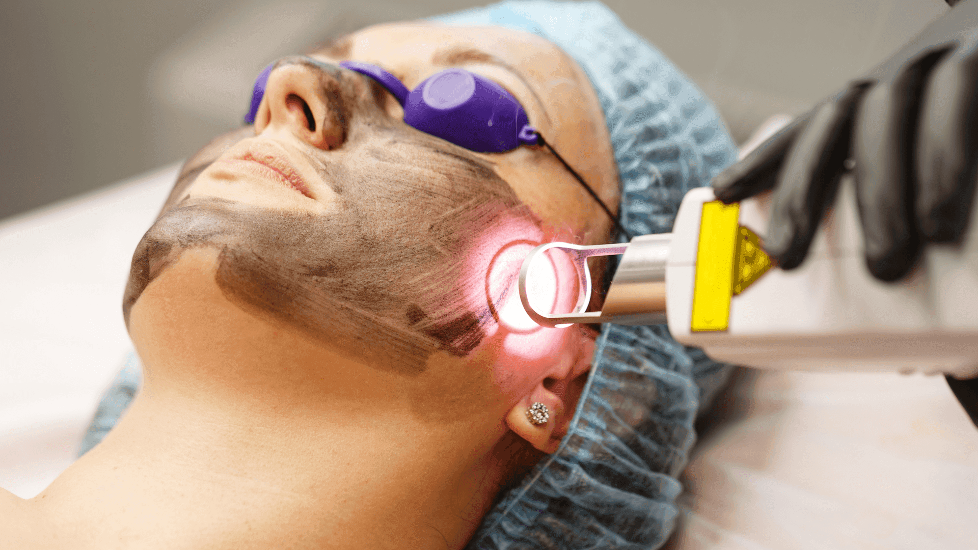 Laser Hollywood Facial
