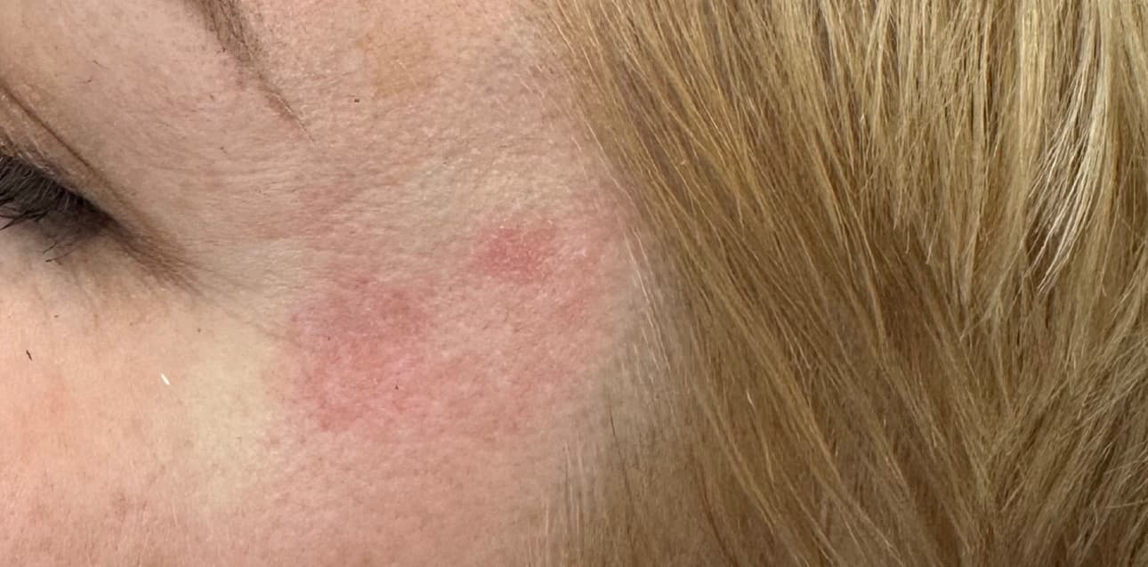 Facials Treatment after