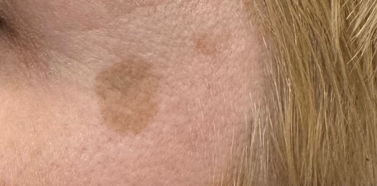 Facials Treatment before