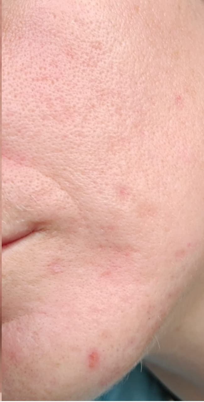 HydraFacial Series after