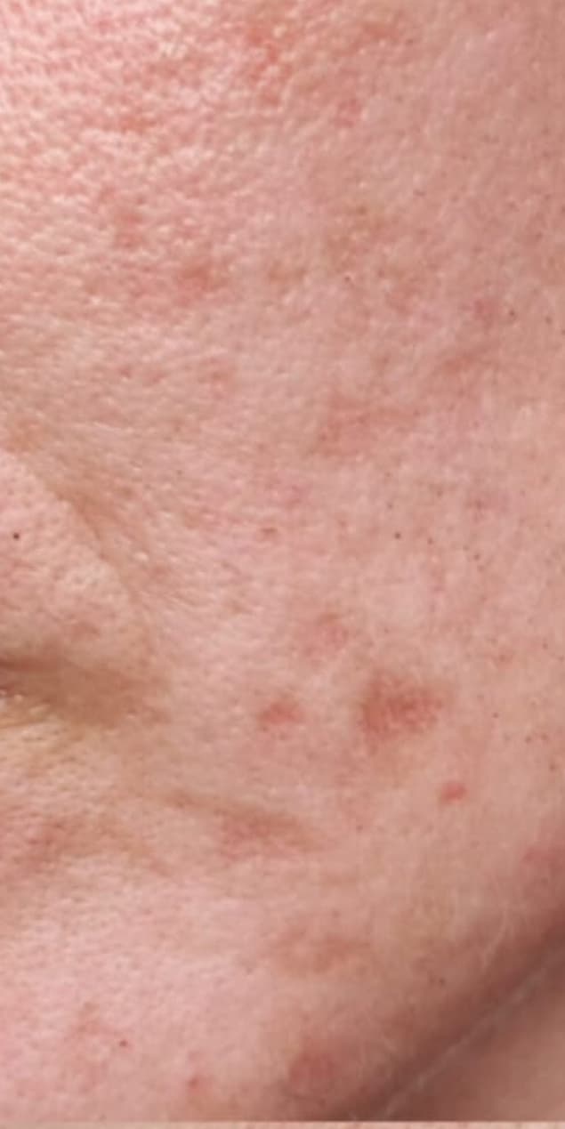 HydraFacial Series before