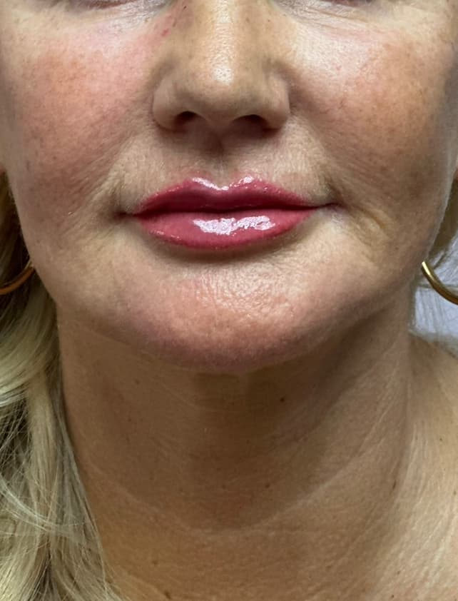 Facial Contouring after