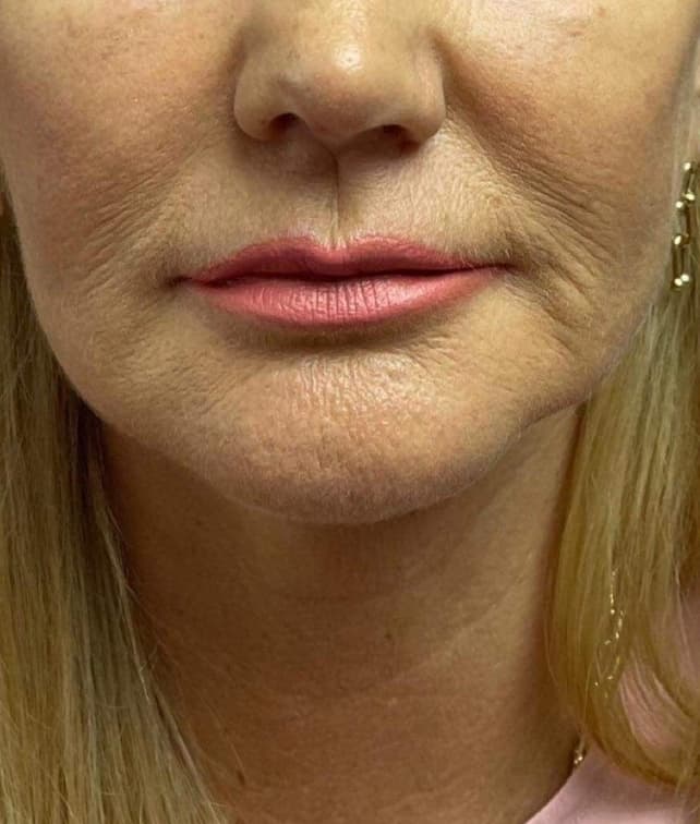 Facial Contouring before